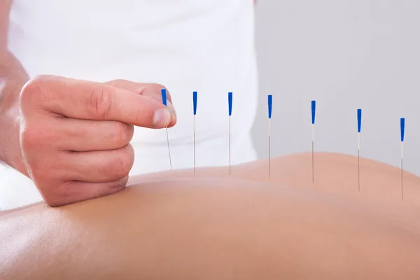 depositphotos_29295991-stock-photo-woman-receiving-an-acupuncture-therapy