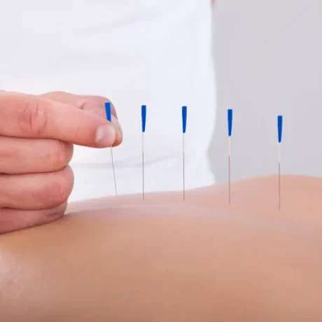 depositphotos_29295991-stock-photo-woman-receiving-an-acupuncture-therapy